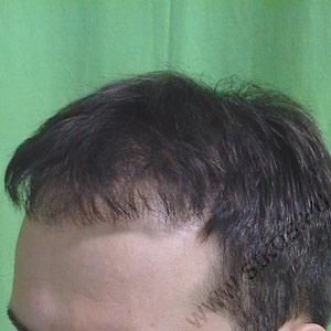 Hajátültetés ( Hajbeültetés ) után