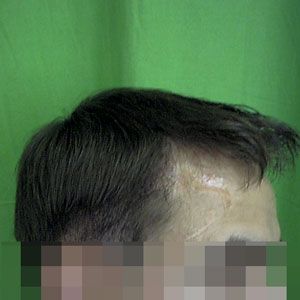 Égési sérülés okozta hajhiány hajátültetés (hajbeültetés) után