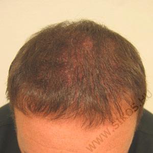 2. Hajátültetés, hajbeültetés után 10 hónappal