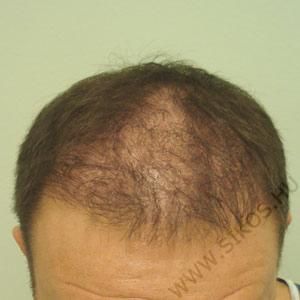 Hajátültetés, hajbeültetés után 5 évvel, 2. műtét előtt